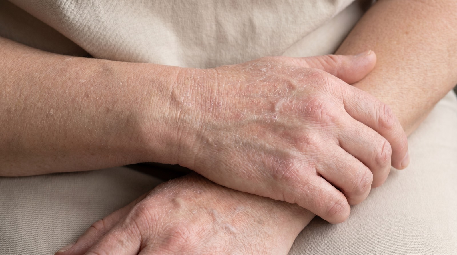 Close-up of an adult's hands with dry, flaky, mildly irritated skin